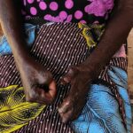 Lepra in Senegal: Touba registreert 25% van de gevallen