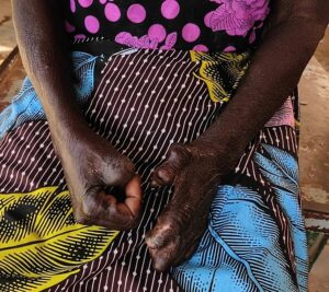 Lepra in Senegal: Touba registreert 25% van de gevallen