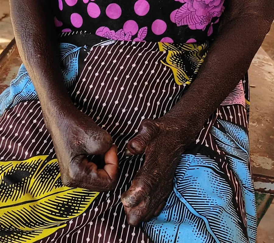 Lepra in Senegal: Touba registreert 25% van de gevallen